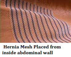 hernia-mesh-placed-from-inside-abdominal-wall