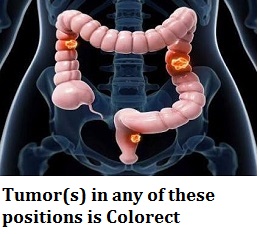q24-tumors-in-any-of-these-positions-is-colorect