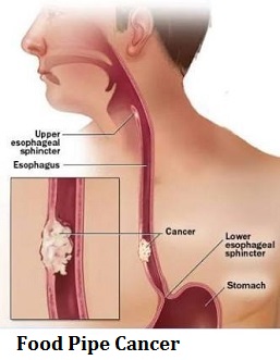 q6-food-pipe-cancer